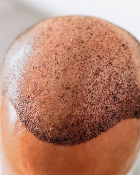 Hair Transplantation